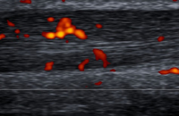 Chronic Achilles Tendon Pain | What is the role of MRI and ultrasound?